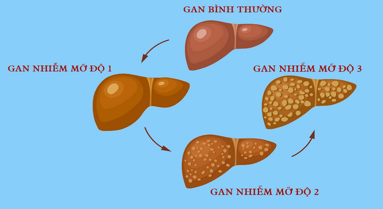 4 Nguyên nhân gan nhiễm mỡ tiềm ẩn