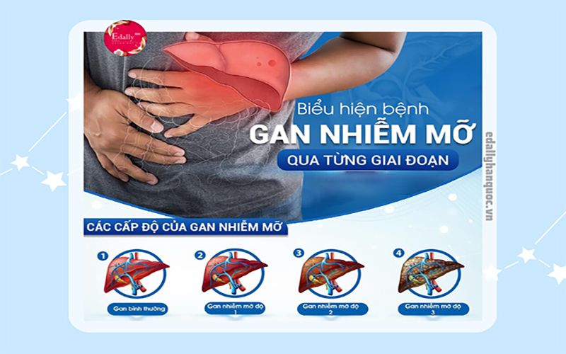 Dấu hiệu gan nhiễm mỡ dau-hieu-gan-nhiem-mo