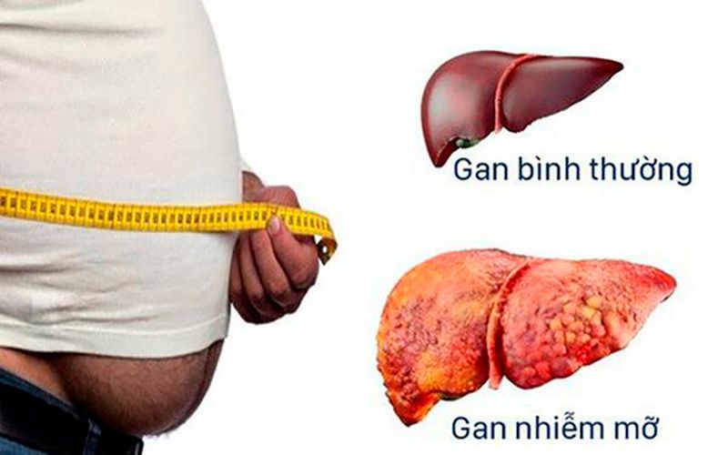 Gan nhiễm mỡ độ 2 Nguyên nhân, triệu chứng và cách điều trị hiệu quả 33 Gan nhiễm mỡ độ 2