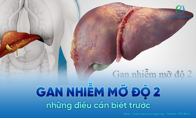 Gan nhiễm mỡ Nguyên nhân, triệu chứng, chẩn đoán và cách điều trị hiệu quả 6 Gan nhiễm mỡ Nguyên nhân, triệu chứng, chẩn đoán và cách điều trị hiệu quả