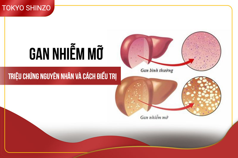 Gan nhiễm mỡ Nguyên nhân, triệu chứng, chẩn đoán và cách điều trị hiệu quả 7 Gan nhiễm mỡ Nguyên nhân, triệu chứng, chẩn đoán và cách điều trị hiệu quả