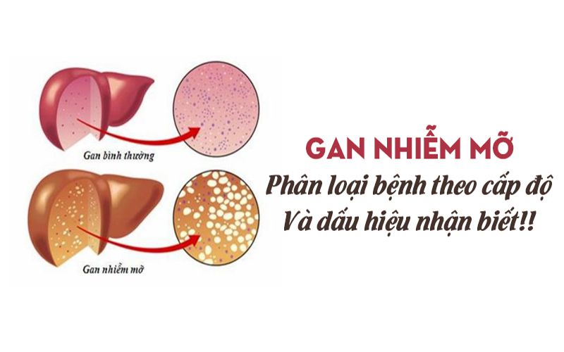 Gan nhiễm mỡ Nguyên nhân, triệu chứng, chẩn đoán và cách điều trị hiệu quả 11 gan-nhiem-mo