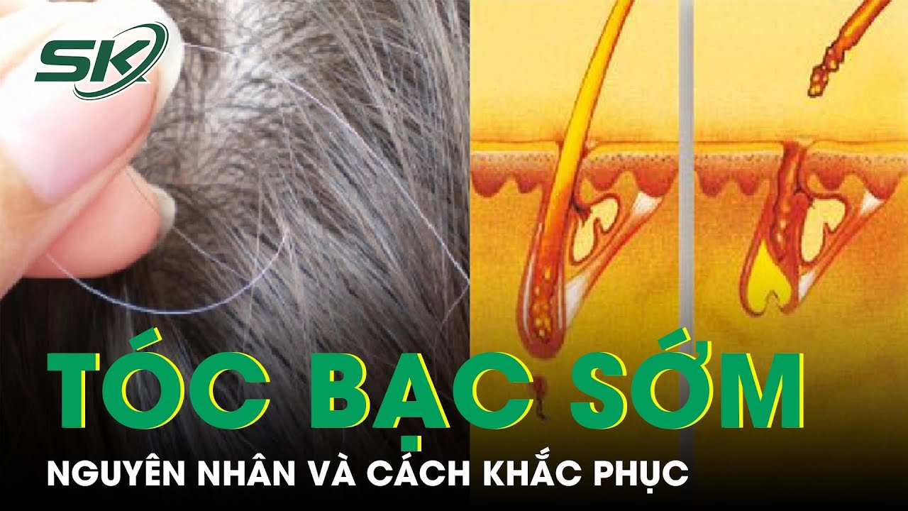 Nguyên nhân tóc bạc sớm ở nữ giới