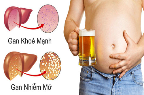 Nguyên tắc và cách điều trị gan nhiễm mỡ hiệu quả bằng thảo dược 3 Nguyên tắc và cách điều trị gan nhiễm mỡ hiệu quả bằng thảo dược