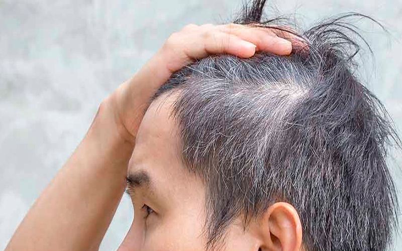 Tóc bạc sớm ở nam Nguyên nhân, triệu chứng và cách khắc phục 30 toc-bac-som-o-nam