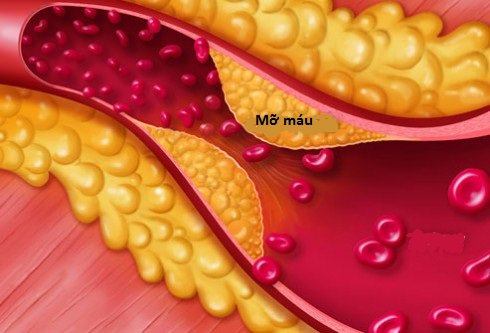 Máu nhiễm mỡ nên ăn gì Thực phẩm nên hạn chế và lưu ý khi ăn uống 7 Máu nhiễm mỡ nên ăn gì Thực phẩm nên hạn chế và lưu ý khi ăn uống
