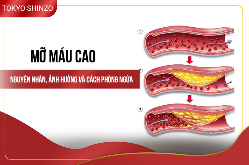 mo mau cao nguyen nhan trieu chung va cach kiem soat hieu qua 6683c356b4806